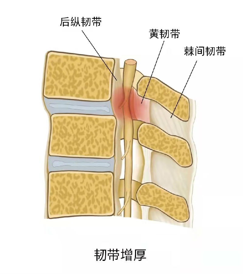 椎管狭窄图片解析图片