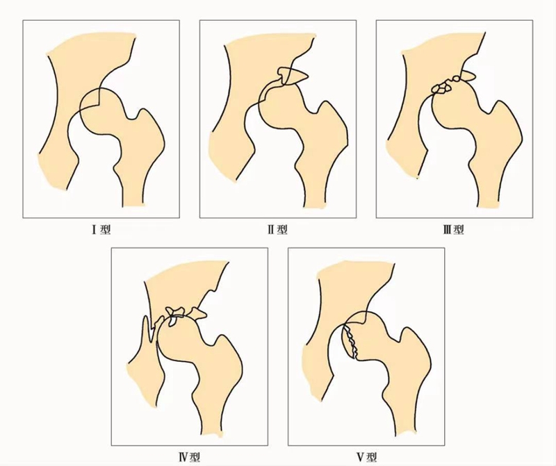 这些常用髋关节脱位分型