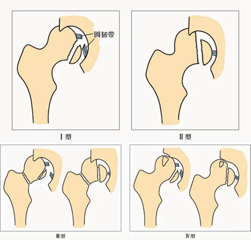 这些常用髋关节脱位分型